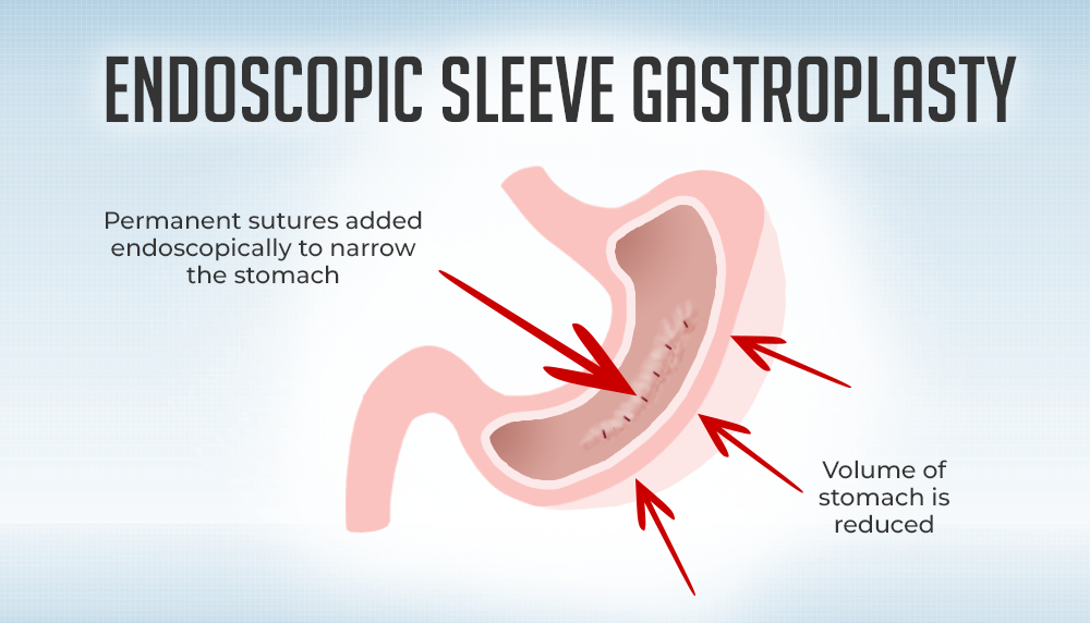 ENDOSCPOIC SLEEVE GASTROPLASTY